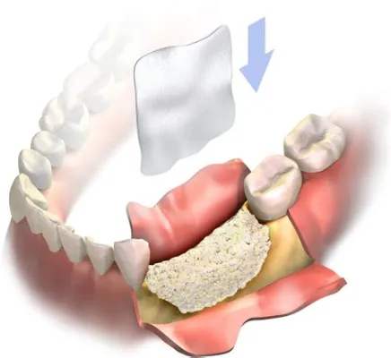  Wollastonite: A Biocompatible Powerhouse for Bone Regeneration and Dental Implants!